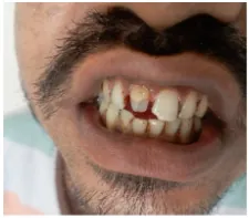 Before aesthetic ceramic crown treatment at Transcend Dental Clinic Hinjawadi Pune