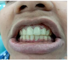 After aesthetic front teeth repair at Transcend Dental Clinic Hinjawadi Pune