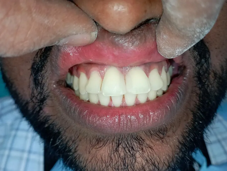 After dental smile correction treatment at Transcend Dental Clinic Hinjawadi Pune