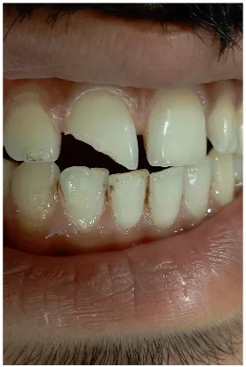 Before broken tooth repair by composite at Transcend Dental Clinic Hinjawadi Pune