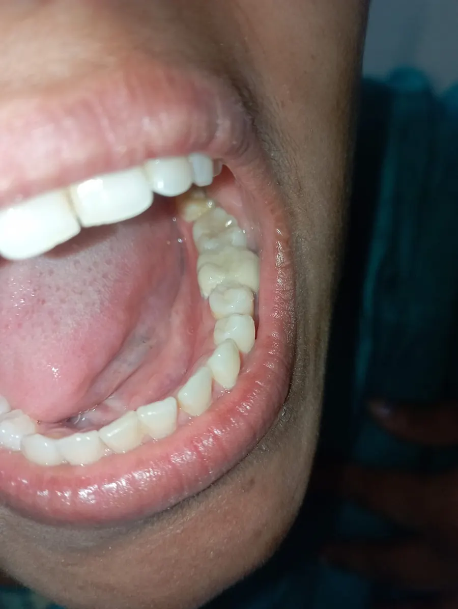After ceramic cap placed following root canal treatment at Transcend Dental Clinic Hinjawadi Pune