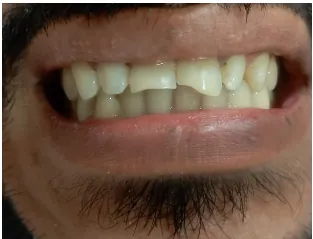 Before composite teeth repair at Transcend Dental Clinic Hinjawadi Pune