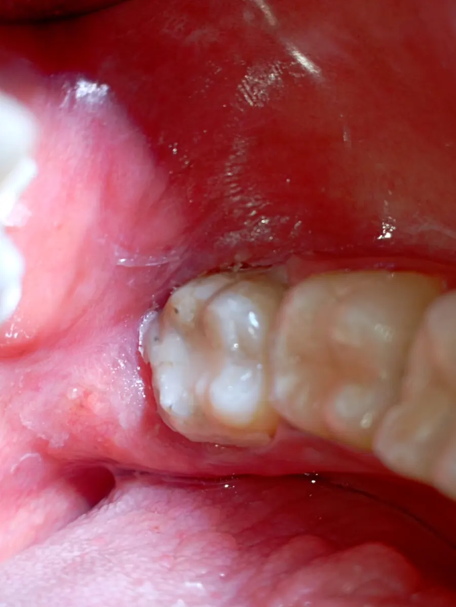 After permanent composite filling treatment at Transcend Dental Clinic Hinjawadi Pune