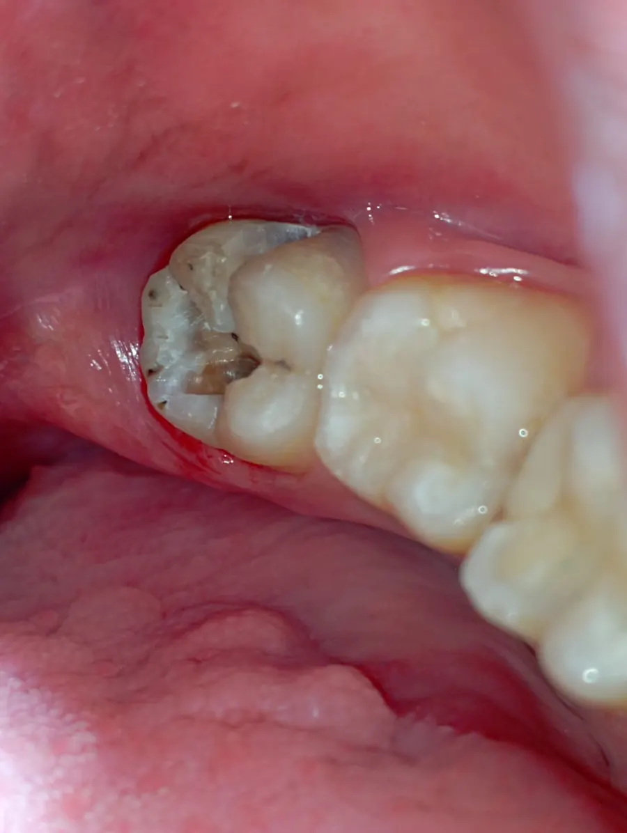 Before permanent composite filling treatment at Transcend Dental Clinic Hinjawadi Pune