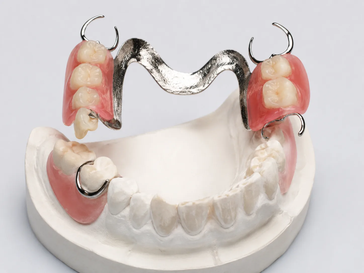 Partial Denture at Transcend Dental Clinic Hinjawadi Pune