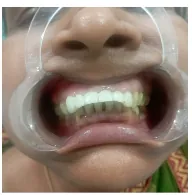 After zirconia crowns and bridges fixed to fill teeth gaps at Transcend Dental Clinic Hinjawadi Pune